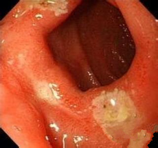 淺表型慢性胃炎萎縮