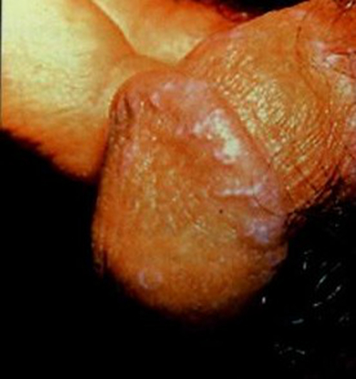包皮龜頭炎潰瘍面