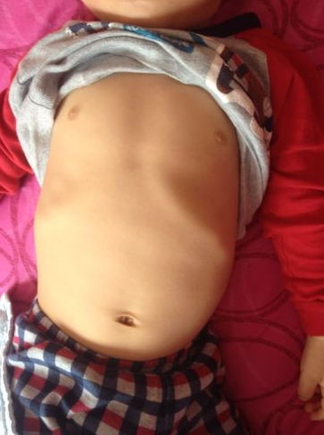 寶寶缺鈣雞胸圖 (5) 