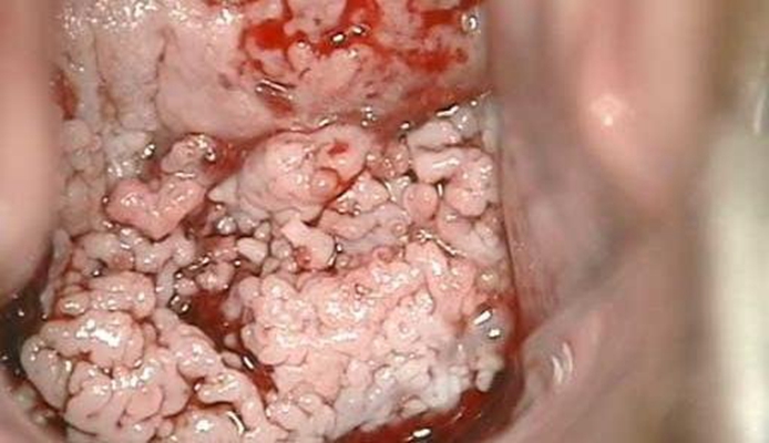 宮頸癌的早期症狀