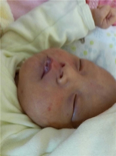 新生兒肺炎吐泡泡 (6) 