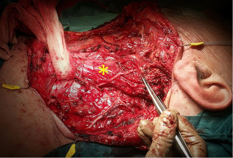 甲狀腺癌治療手術