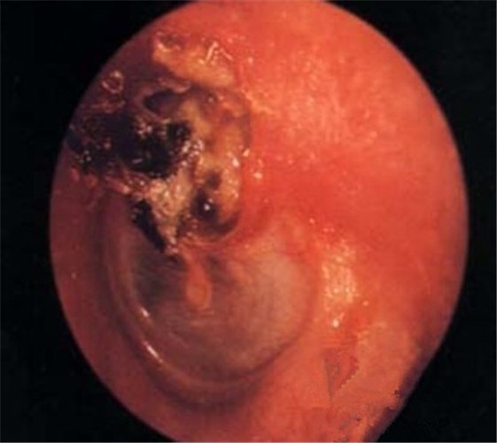 炎症導致的鼓膜穿孔