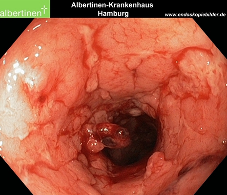 直腸癌晚期症狀 (42) 