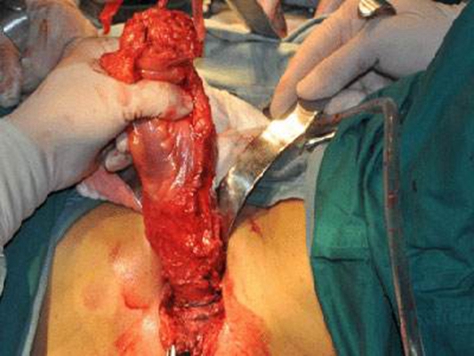 直腸癌晚期症狀 (56) 