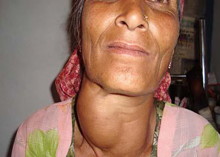 右側甲狀腺腫大疼