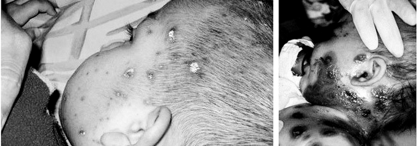 小孩得天花病毒