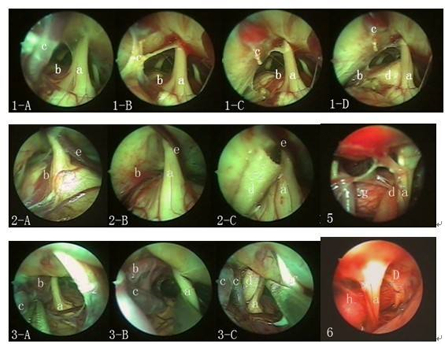 小腦腦梗塞組圖