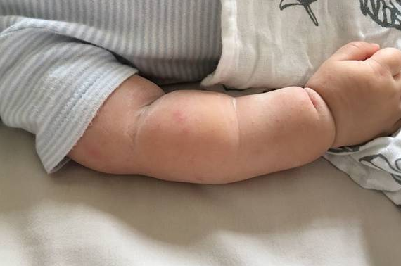 身體蟎蟲過敏症狀