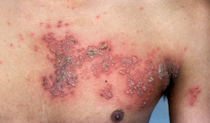 帶狀皰疹樣外觀