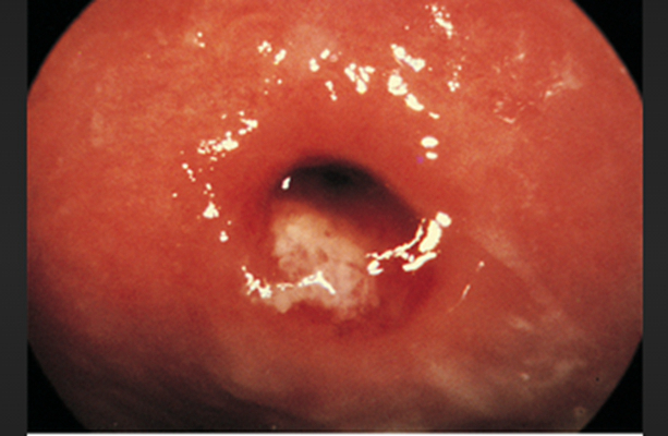 淋病的症狀 (55) 