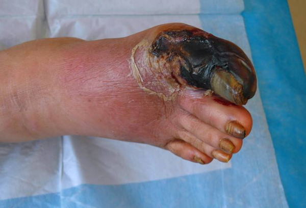 脈管炎早期症狀