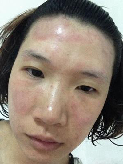 神經性皮炎的治療 (60) 