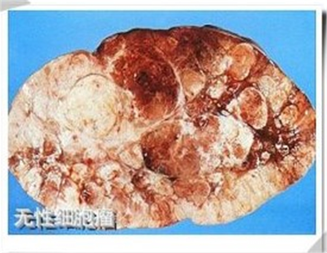 卵巢癌無性細胞瘤