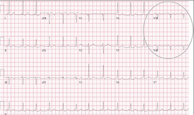 預激綜合徵心電圖 (79) 