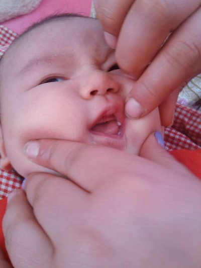 口腔念珠菌感染 (5) 