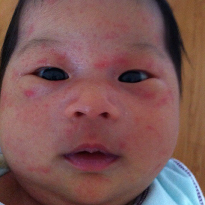 新生兒胎毒的症狀