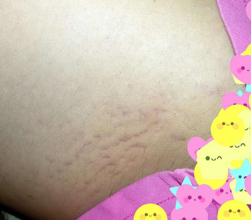 懷孕中期妊辰紋