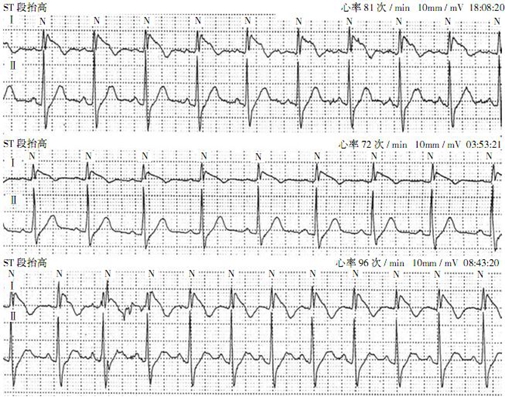 高鉀血癥心電圖 (56) 