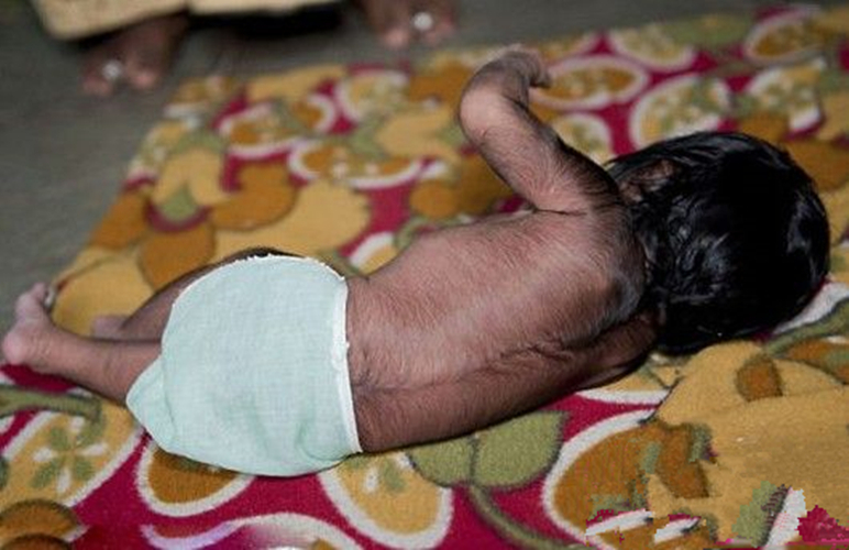 新生兒遺傳性多毛症