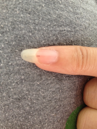 手指甲上有豎紋圖解 (9) 