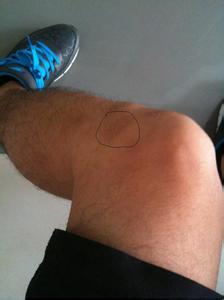 脛骨結節骨骺炎 (50) 