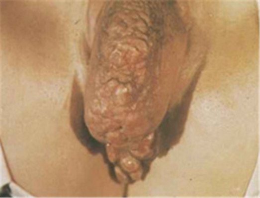 性病性淋巴肉芽腫套圖 (52) 