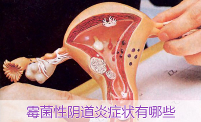 黴菌陰炎症狀 (38) 