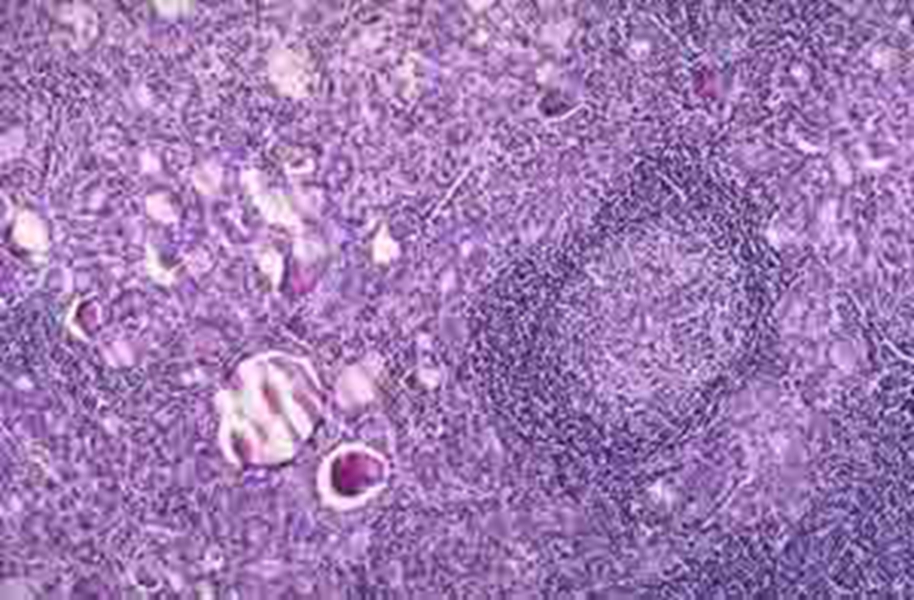 橋本甲狀腺炎細胞