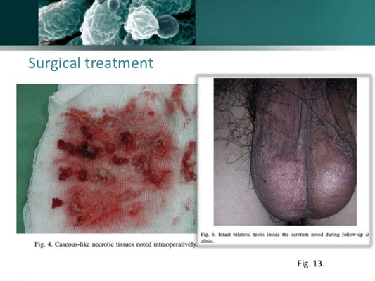 睪丸癌的早期症狀 (43) 