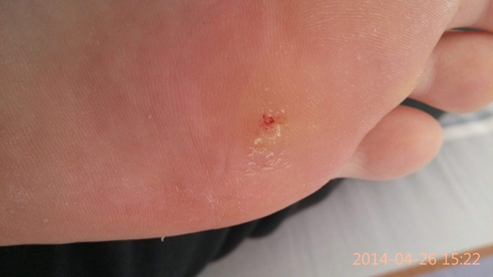腳底蹠疣早期