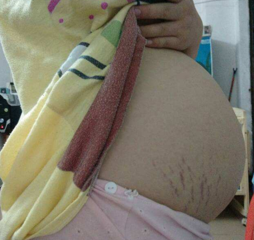 懷孕期的女性妊辰紋