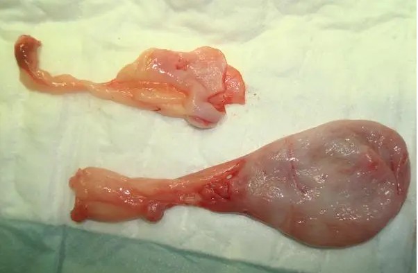 子宮肥大圖 (36) 