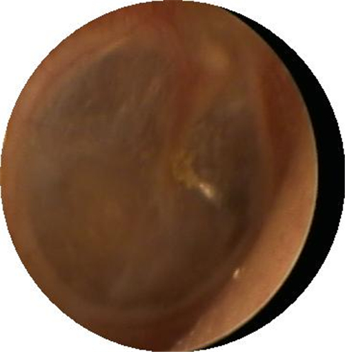 自愈的鼓膜穿孔