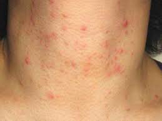 脖子異位性皮炎正面