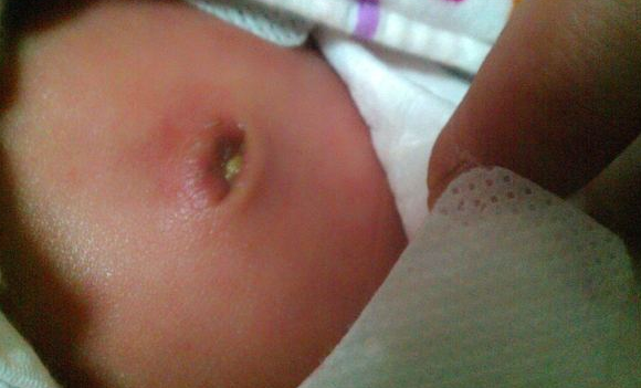 寶寶臍帶脫落後