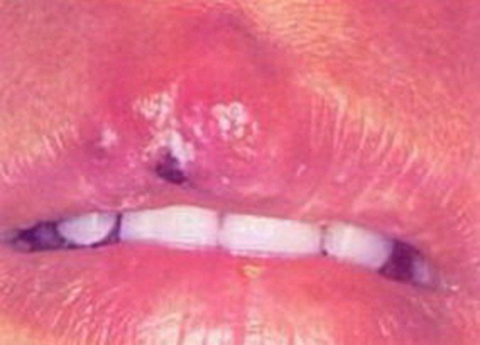 口唇皰疹結痂的