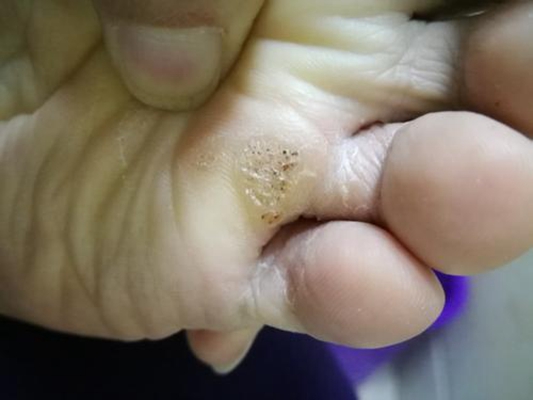 腳底蹠疣早期