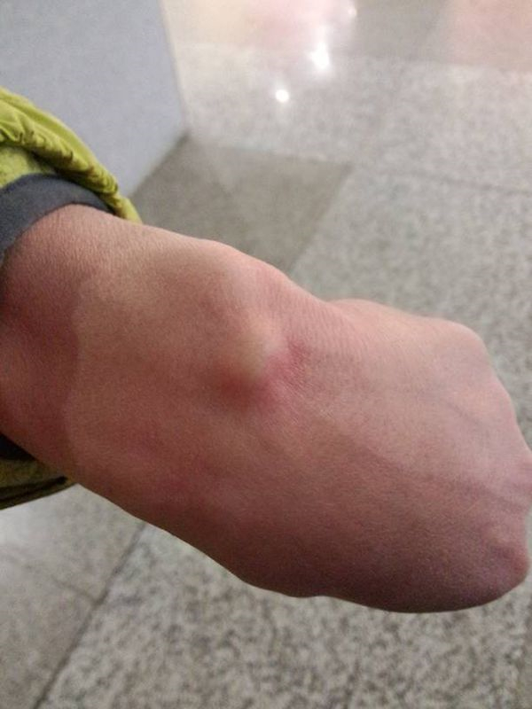 有些紅腫的手腕腱鞘炎