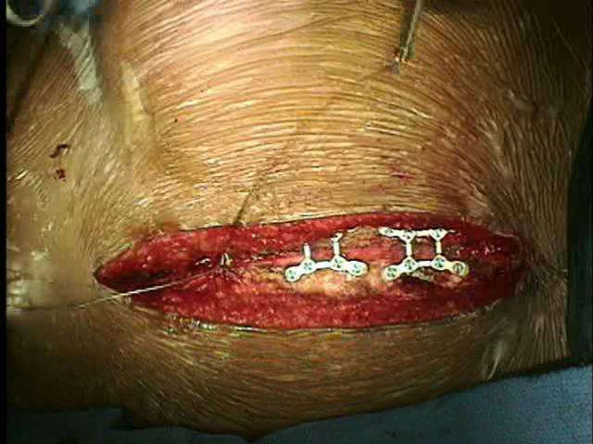 手術固定肋骨骨折