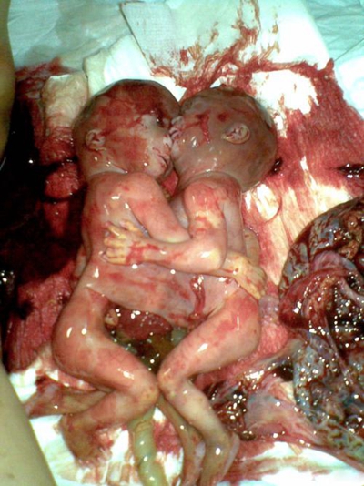 胎兒畸形 (46) 