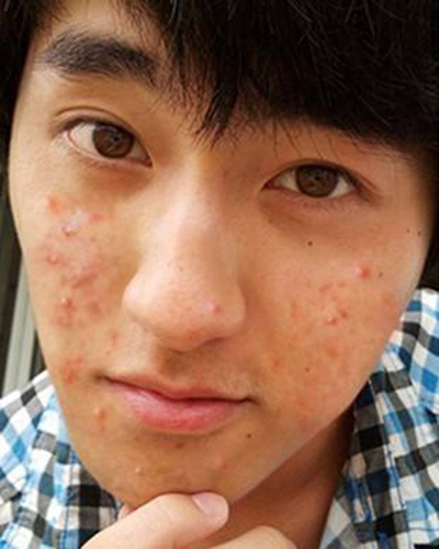 血熱的症狀痘痘