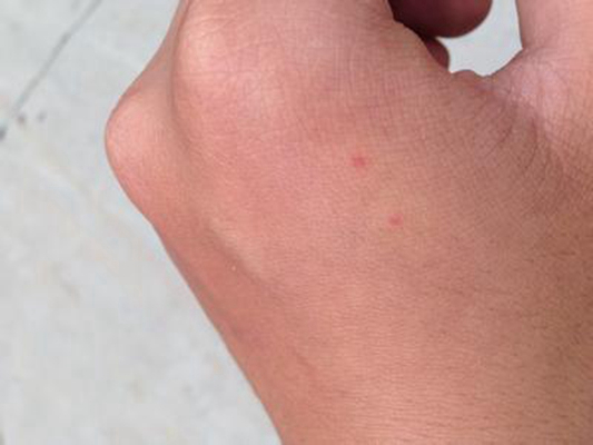 艾滋病紅疹症狀