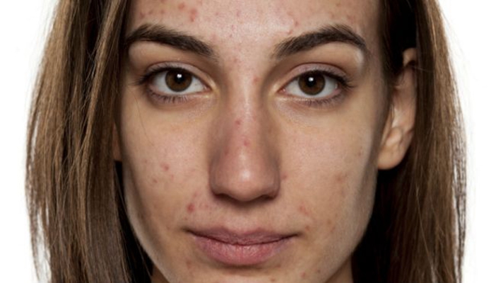 激素臉排毒症狀 (6) 