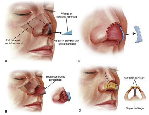 鼻中隔彎曲手術圖解 (7) 