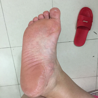 腳底乾裂 (4) 