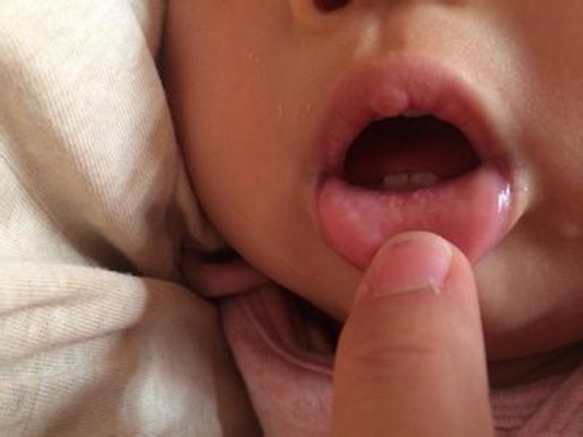 口腔念珠菌感染 (33) 