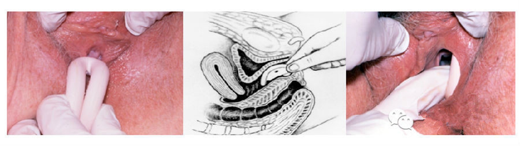 子宮脫垂子宮託