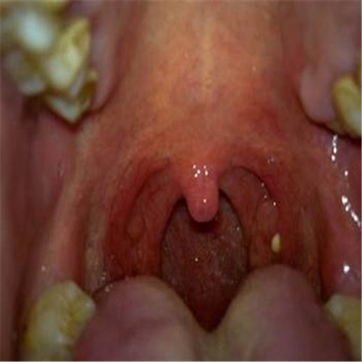 扁桃體癌圖  (51) 