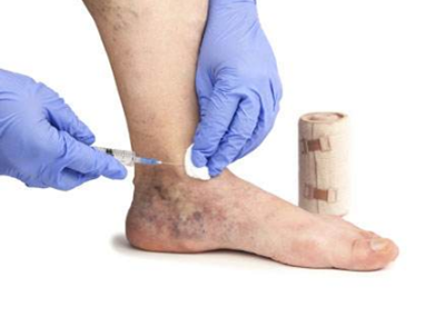 脈管炎早期症狀